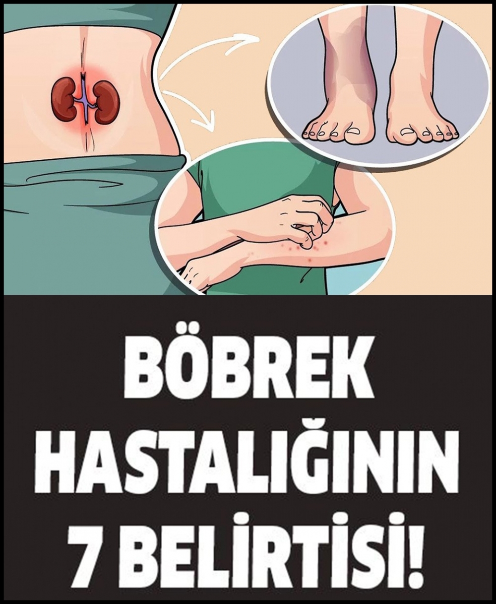 Böbrek Hastalığının 7 Beliirtisi galerisi resim 1