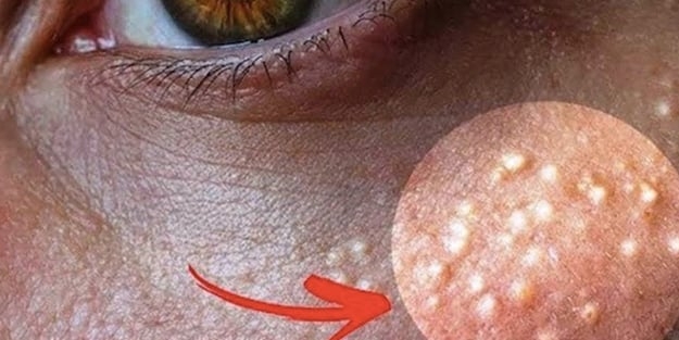 Yağ Bezesi (Lipom) Nasıl Geçer? 6 Doğal Destek galerisi resim 2