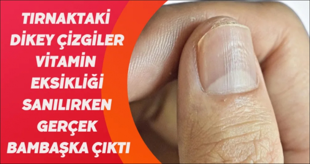 Tırnak Soyulması Hangi Hastalığın Belirtisi galerisi resim 2