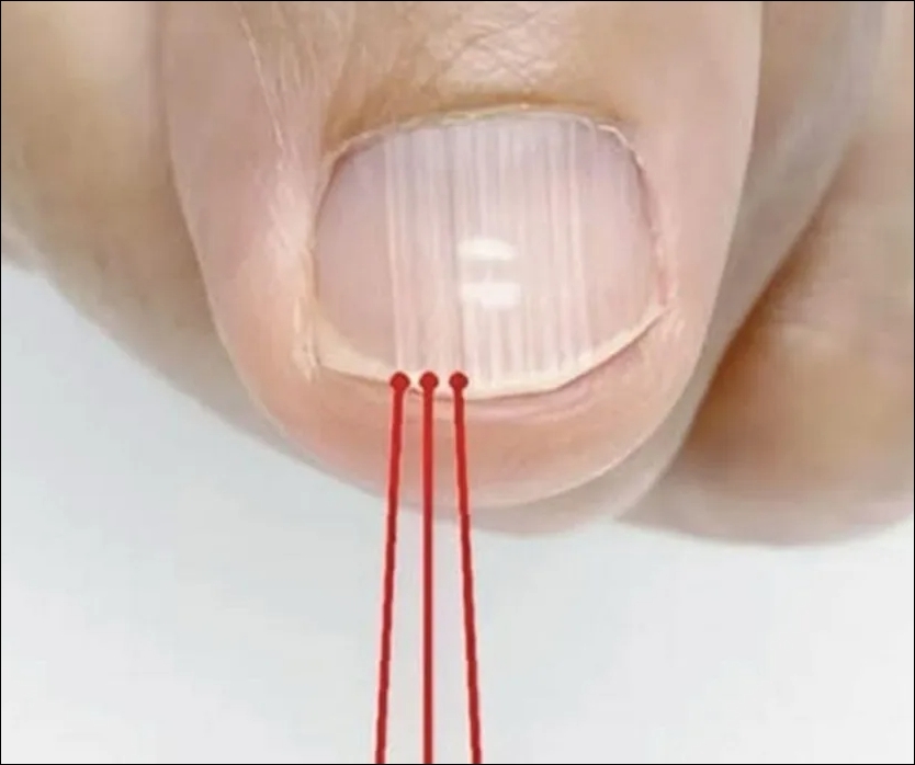 Tırnak Soyulması Hangi Hastalığın Belirtisi galerisi resim 3