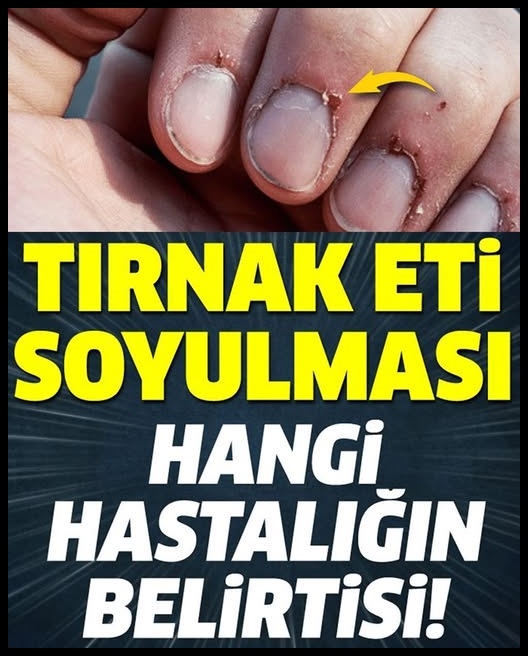 Tırnak Soyulması Hangi Hastalığın Belirtisi