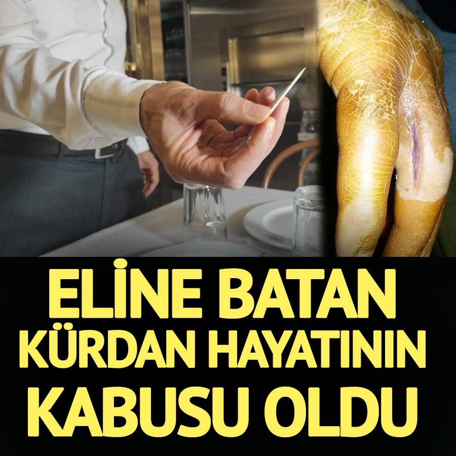 Eline batan kürdan kabusu oldu galerisi resim 1