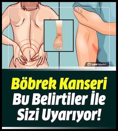 Böbrek Kanserinin Bu Belirtilerine Diikkat!!