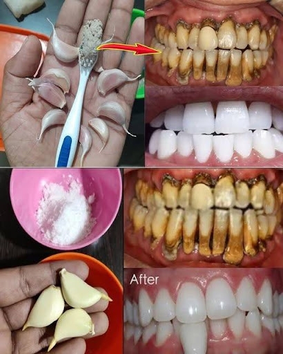 Sadece 2 dakikada tartarları çıkarın ve dişlerinizi beyazlatın. galerisi resim 1