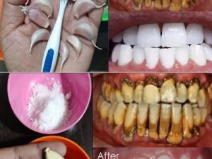 Sadece 2 dakikada tartarları çıkarın ve dişlerinizi beyazlatın.