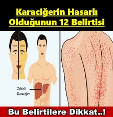 Karaciğerin Çalışmadığına Dair 12 Belirti galerisi resim 1