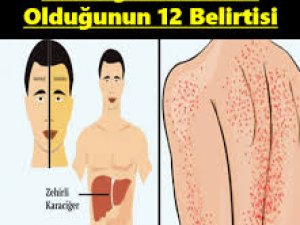 Karaciğerin Çalışmadığına Dair 12 Belirti