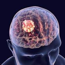 Beyin tümörünün belirtileri galerisi resim 3