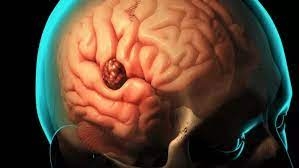 Beyin tümörünün belirtileri galerisi resim 4