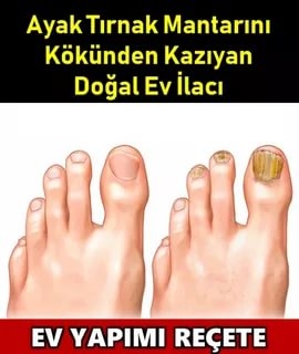 Ayak tırnak mantarını kökünden kazıyan doğal ev ilacı galerisi resim 1