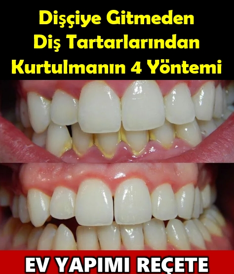 Diş Tartarlarından Kurtaran 4 Reçete galerisi resim 1