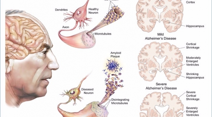 Alzheimer'in 12 belirtisi galerisi resim 6