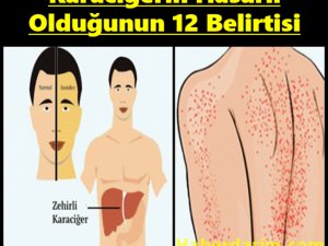 Karaciğerin Çalışmadığına Dair 12 Belirti