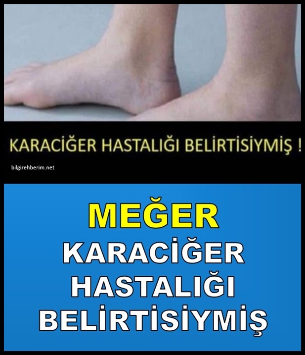 MEĞER KARACİĞER HASTALIĞI BELİRTİSİYMİŞ galerisi resim 1