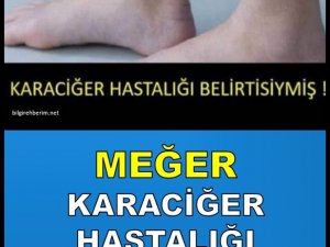 MEĞER KARACİĞER HASTALIĞI BELİRTİSİYMİŞ