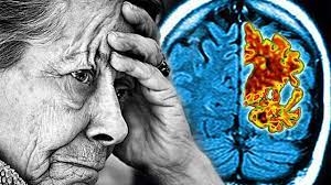 Alzheimer'ın asıl belirtisi unutkanlık değilmiş! galerisi resim 3