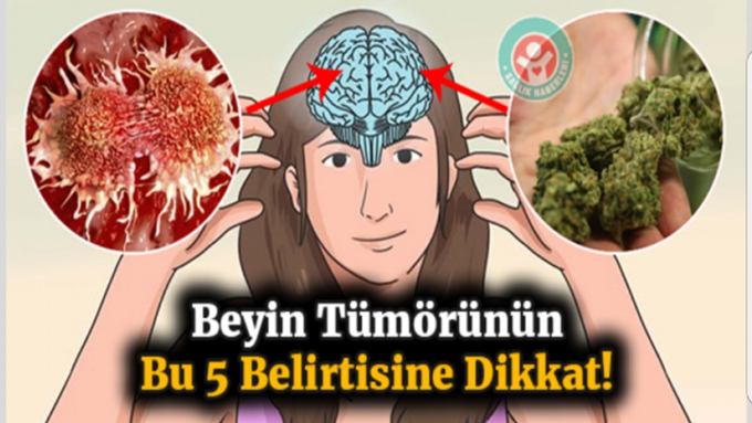 Beyin tümörünün bu 5 belirtisini öğrenmelisiniz!