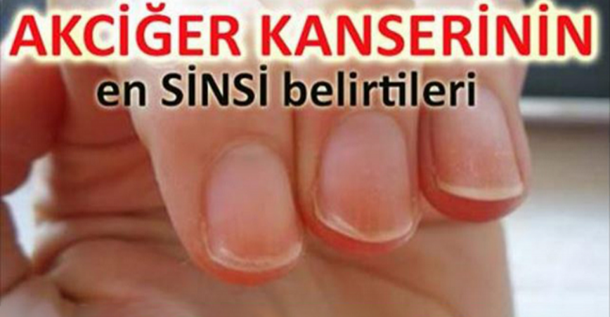 Akciğer Ka-nserinin En Sinsi 9 Belirtisi