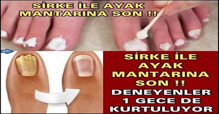 Sirke ile Ayak Mantarına S-on. Deneyenler 1 Günde Kurtuluyor.