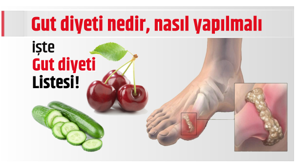 Gut Hastalığı Nedir? Belirtileri Nelerdir? Neden Olur? Bitkisel Tedavisi