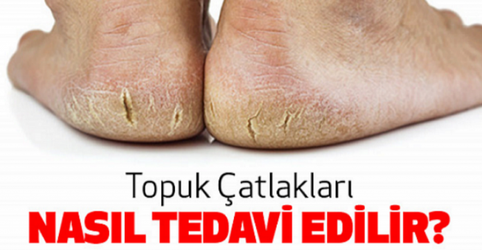 Topuk Çatlakları Tedavisi Nedir ?