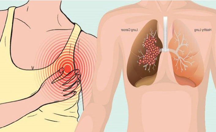 Çağımızın Ölümcül Hastalığı Akciğer Kanserinin 12 Belirtisi