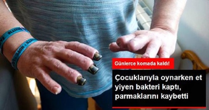 Çocukları ile Bahçede Oynarken Et Yiyen Bakteri Kapan Adamın Parmakları Kaybetti