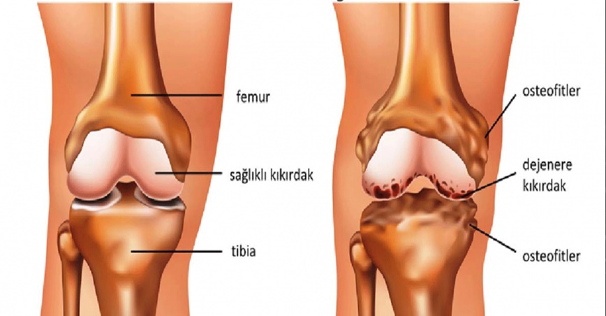 Diz Eklem Sorunları İçin Ballı Karışım