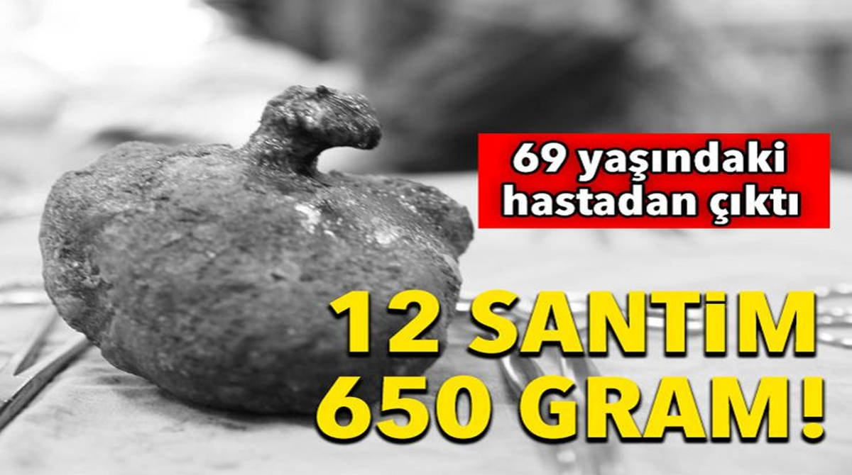 69 Yaşındaki Hastadan Çıktı..12 cm 650 Gram !