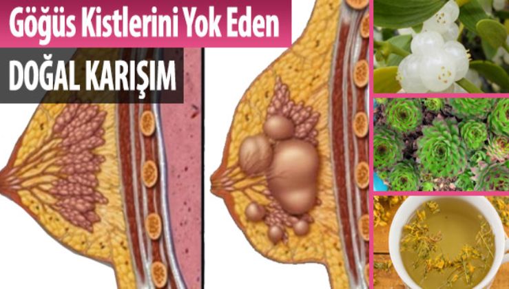 GÖĞÜS KİSTLERİNİ YOK EDEN DOĞAL KÜR TÜM BAYANLAR...