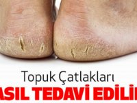 Topuk Çatlakları Tedavisi Nedir ?