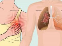 Çağımızın Ölümcül Hastalığı Akciğer Kanserinin 12 Belirtisi