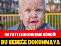 HAYATI CEHENNEME DÖNDÜ! BU BEBEĞE DOKUNMAYA KORKUYORLAR!