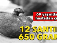 69 Yaşındaki Hastadan Çıktı..12 cm 650 Gram !